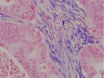 miR-21 detection in colon adenocarcinoma.